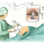 Arthroscopy - Knee