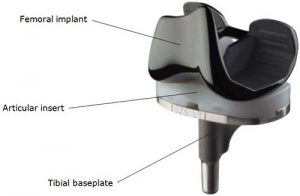 Best Implant for Knee Replacement Surgery